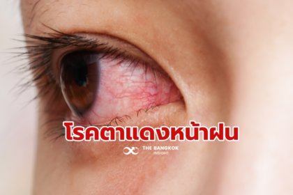 รูปข่าว ‘โรคตาแดง’ ทำไมระบาดหน้าฝน รพ.เมตตาฯ เฉลย พร้อมแนะดูแลสุขภาพดวงตา